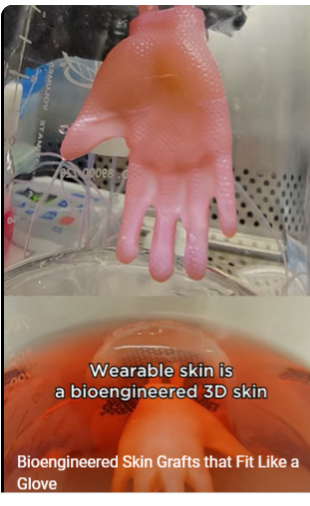 Des greffes de peau bio-ingénierie qui vont comme un gant